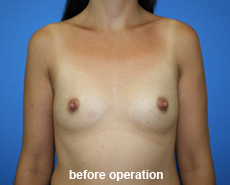 plastic-surgery-breast-augmentation
